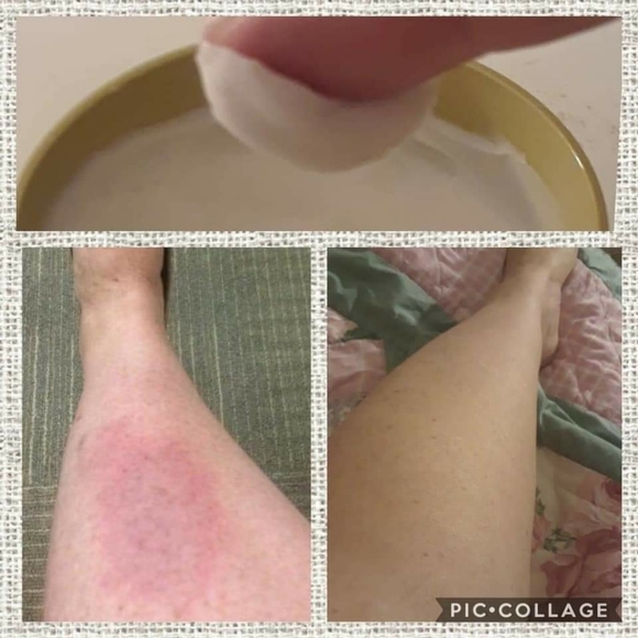 PREORDER ONLY ByeBye Stretch Marks,Mosquitos,Burns - Picture 8 of 16